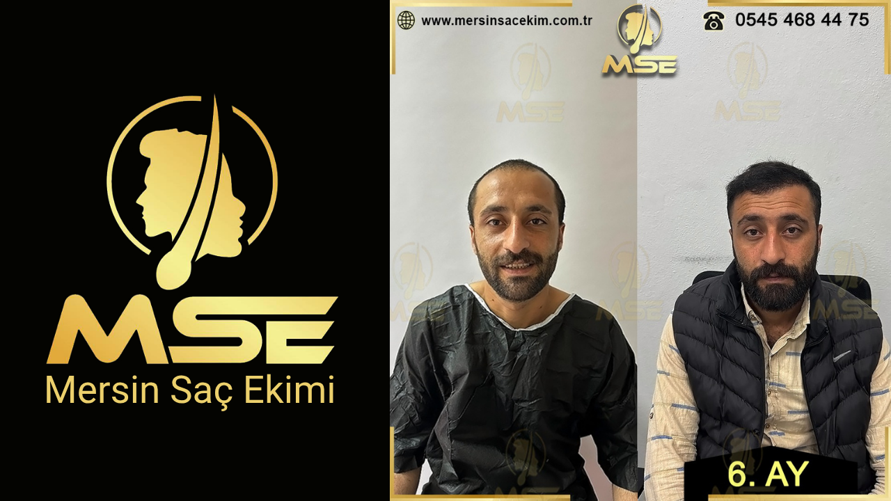 MERSİN SAÇ EKİMİ
